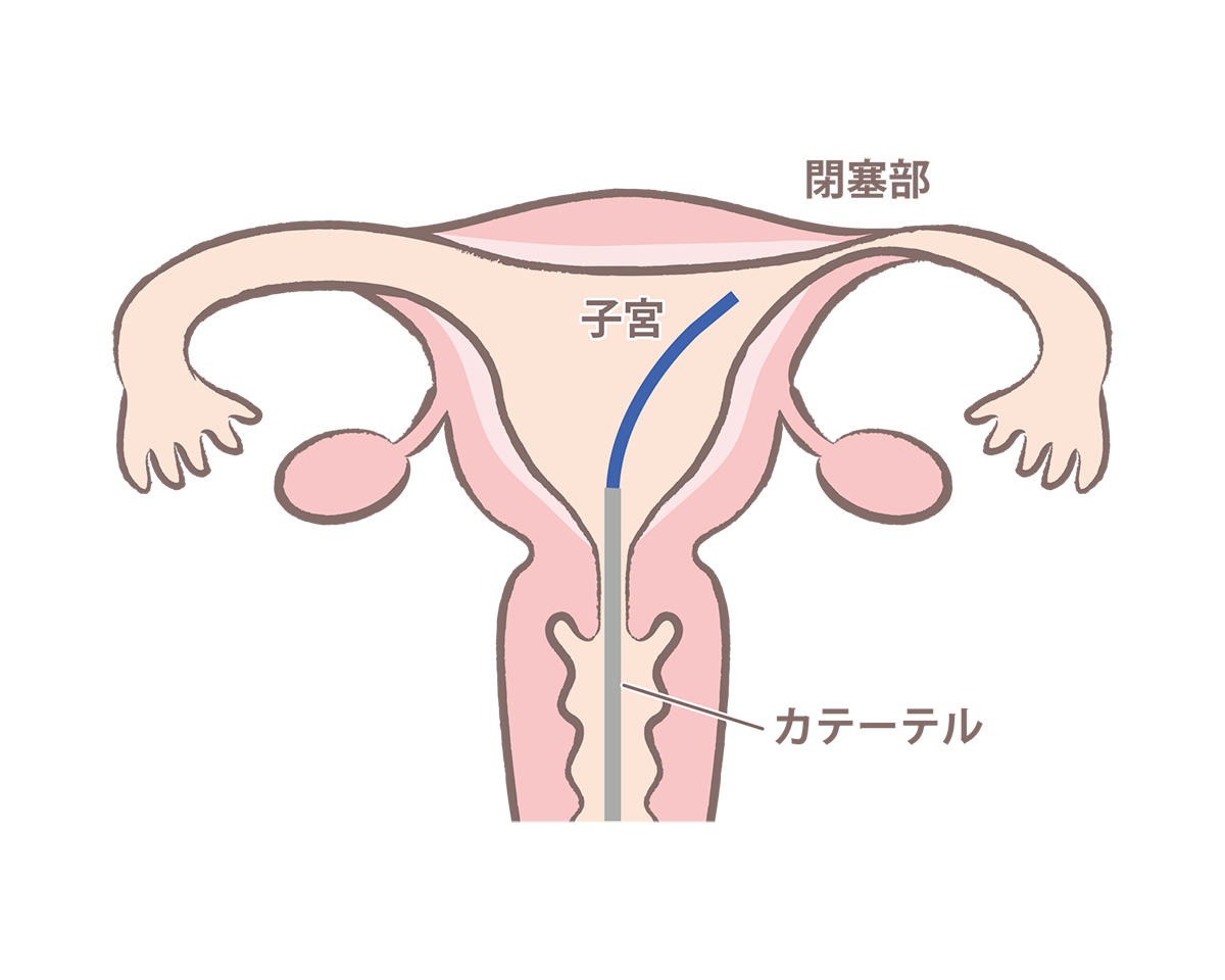 片側閉塞・狭窄