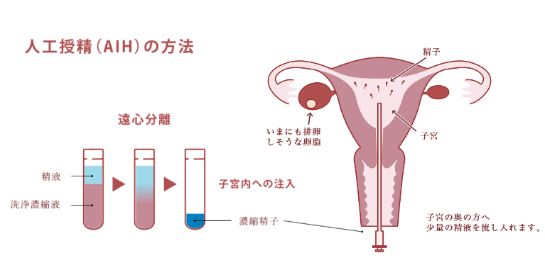 人工授精とは